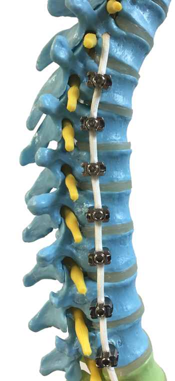 Vertebral Body Tethering – VBT | Vertebral Body Tethering